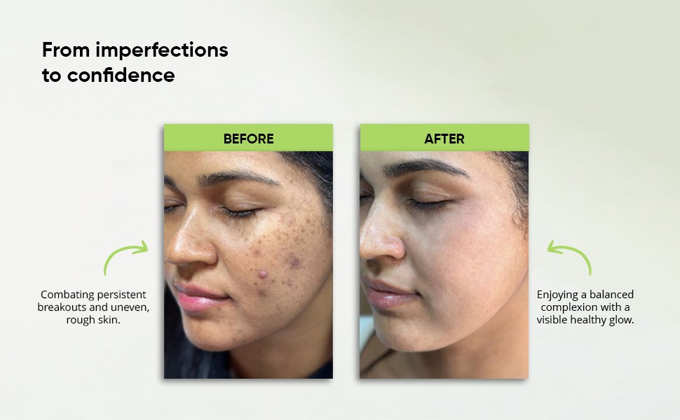 2% Salicylic Acid Face Wash for Acne & Oil Control — A+ content 4